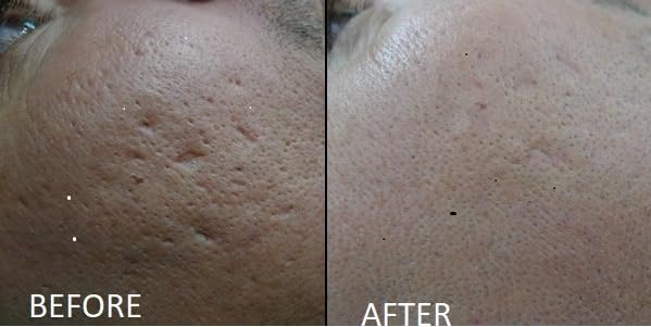 TCAPlatinumDerm 95% Peel (0.3oz/10ml) medium depth chemical peel ideal for Dilutions and spot application on scars with CROSS Technique, for Aestheticians and DIY skincare enthusiasts - Image 4