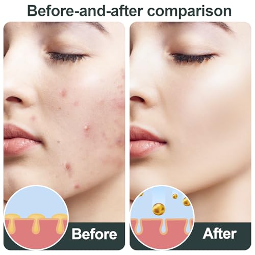 SmallCat 7 folhas de adesivos grandes de espinhas com ácido salicílico, adesivo hidrocolóide de espi