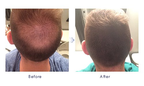 Miniatura 5 de Forila Corrector de pérdida de cabello de fibras de construcción de cabello, 0.81 oz - marrón oscuro