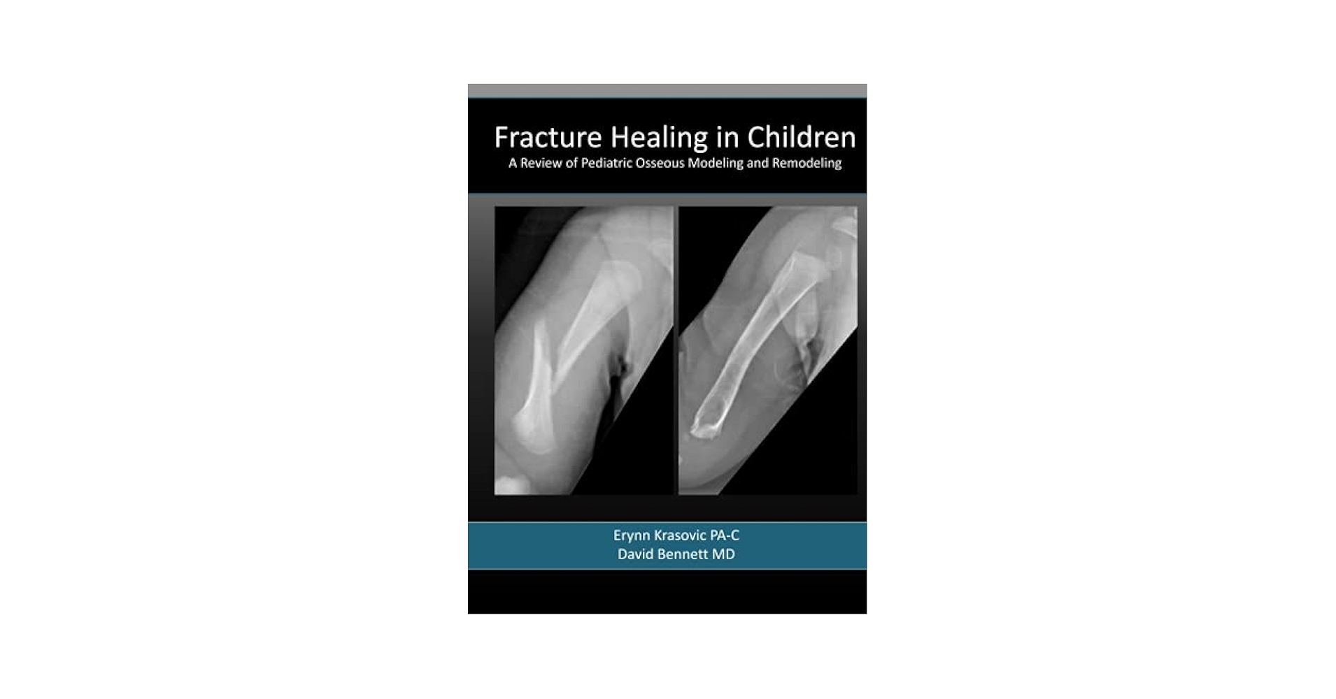 健康・医学 Rockwood Fractures in Children, 10th ed 健康・医学 Rockwood Fractures in Children, 10th ed Amazon