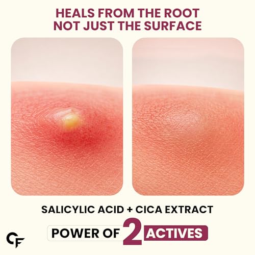 Image of Carbamide Forte Pimple Patches for Face Salicylic Acid & Cica | 72 Hydrocolloid Acne Patch | Invisible Waterproof Pimple Patch Absorbs Pus & Impurities for All Skin Types