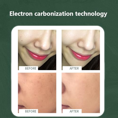 Removedor de etiquetas de pele, caneta de remoção de toupeira, ajuste de nove velocidades e visor LC