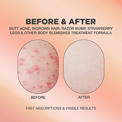 Butt Acne & Ingrown Hair Treatment Serum | Aha & Bha Butt Acne And Ingrown Hair Treatment For Bikini Area | Get Rid Of Butt Acne, Ingrown Hair, Back Acne, Strawberry Legs, Kp And Razor Bump | After Waxing Skin Care | Glycolic And Salicylic Acid Body Serum For Ingrown Hair, Butt And Back Acne Treatment Strawberry Legs | Ingrown Hair Cyst Treatment Formula For All Skin Type | Formulated With Centella Asiatica, Green Tea, Rosemary And Natural Ingredients | 1.69 Oz #TOP2
