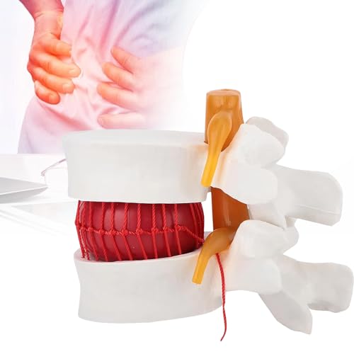 Modelo de columna lumbar con disco intervertebral aumentado 1,5X 2