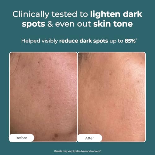 Image of Conscious Chemist Kojic Acid Face Cream | 20g | Azelaic Acid Face Cream for Men & Women, Niacinamide & Tranexamic Acid, Anti Pigmentation, Reduce Dark Spots, All Skin Type - Trubiom (Pack of 2)