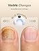 MIYAY Nail Fungus Light, Nail Repair Solution for Damaged, Discolored & Thickened Nails - Easy Home Treatment, Safe & Effective