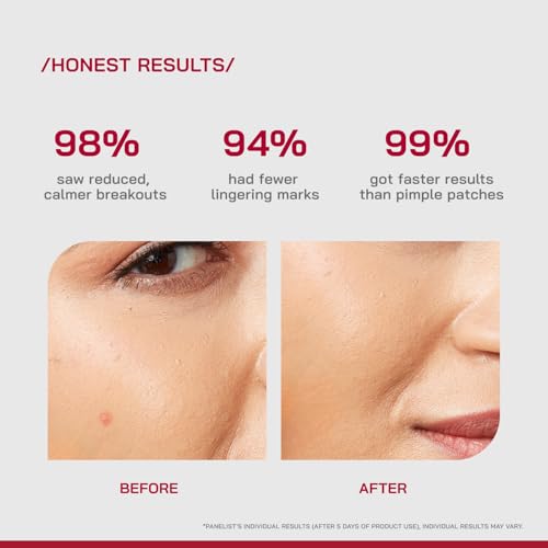 Image of /PHD / Salicylic Acid Acne Spot Treatment Gel 10g | Fast-Acting Pimple Remover & Acne Spot Corrector | Clear Gel with Peptazin Complex | Alternative to Pimple Patches | Salicylic Acid Gel for Face | Targets Breakouts & Reduces Spots Instantly