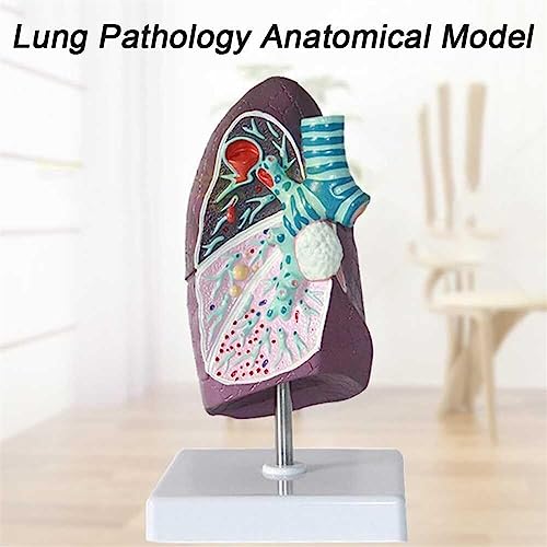Modelo de cáncer de pulmón 2:3 para estudios e investigaciones médicas 6