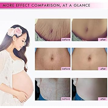 Mango Stretch Marks and Scar Cream, Stretch Mark and Scar Removal Cream for Pregnancy, Belly Creams for Wrinkles, Obesity Fat Marks Scars Moisturizing, Remove Marks (40g)