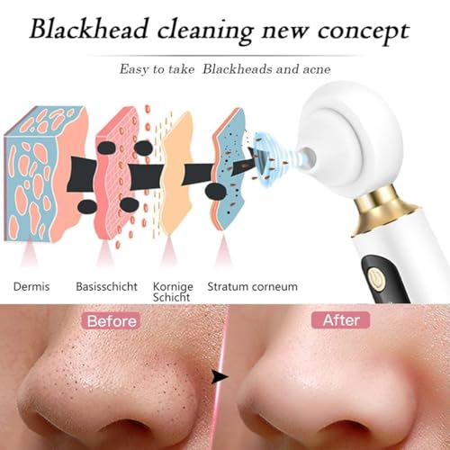 Image of Blackhead Remover, Beautiful Skin Care Expert Acne Pore Cleaner Vacuum Blackhead Remover Kit Skin Cleanser, Pimple Removal Tool With LED 50X Magnifier, 3 In 1 Multi-Function Silicone Blackheads(White Magnifie Derma Suction) (Black) (White)