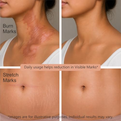 Image of Eraser Ayurvedic Anti Marks & Dark Spots Removal Cream - Unisex (15g) | with Wheat Germ Oil, Haldi, Neem, Rose, Kesar | Dark Circle | Pregnancy Delivery Marks | Pigmentation, Wrinkles | Tan Remover