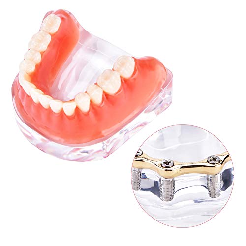 Dental model - tandtanden studiemodel deck prothesentanden minderwaardige precisie implantaat voor de leermonstratie… - Image 7