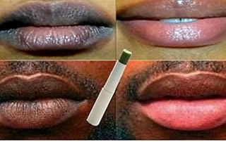N.A.S.E 2PC New Pink Fresh Lightening Cream Blackish Green Balm Treatment Remove Dark Lips
