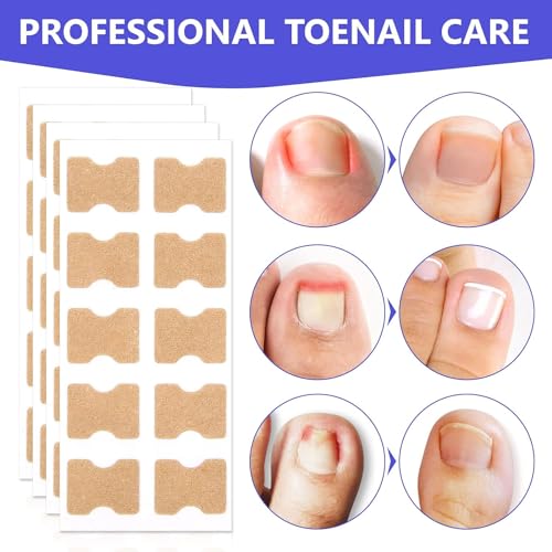 Bravikerly Ingrown Toenail Treatment, 100Pcs Breathable Corrector Patch, Painless Nail Corrector, Ingrown Toenail Strips, Ingrown Nail Treatment Correction Stickers thumb #1