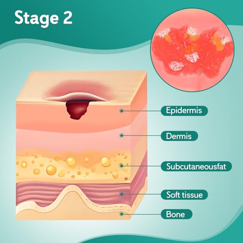 Image of Decubitus Ulcer Wound Care Model, Bedsores Model