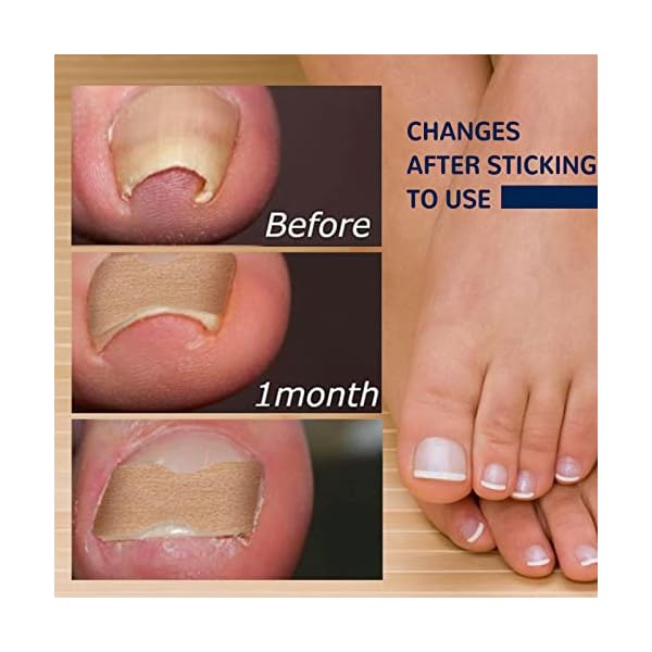 Ingrown Toenail Corrector Treatment Stickers, Glue-free Painless Ingrown Toenail Corrector Strips, Pedicure Toenail Corrector Patch, Professional Toenail Treatment Tool for Foot Care (150pcs) - Image 7