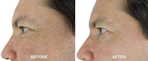 Antiaging Peel Pads-30% Glycolic Cell Renewal Peel Pads+ Salicylic, Lactic Acid, Argireline, Dmae #TOP3