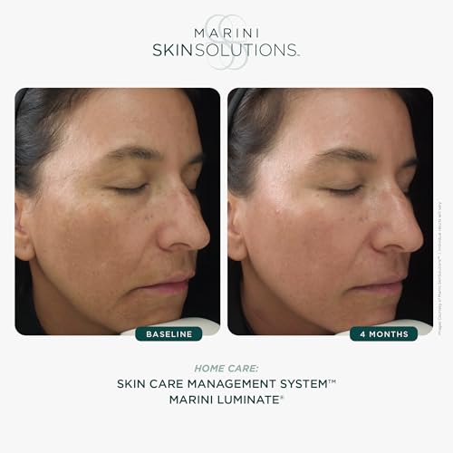 Marini SkinSolutions Luminate Face Lotion - Reduces Appearance of Discoloration, Fine Lines & Wrinkles with Patented Technologies - Outperforms Hydroquinone - Cruelty Free - Made in the USA - 1 fl oz