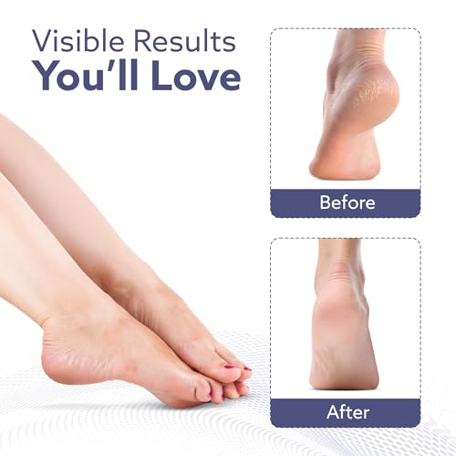 Image of AGARO Callus Remover Replaceable Heads, 2 Pcs, Callus & Dead Skin Removal Filer, Pedicure at Home