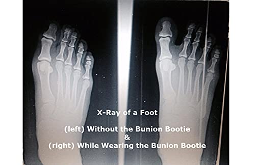 Bunion Bootie Ultra-Thin Bunion Corrector For Women Big Toe Straightener, Bunion Corrector For Men, Bunion Socks For Women Bunion Splint, Hallux Valgus Bunion Relief Bunion Corrector Toe, Xsmall-Right #TOP3