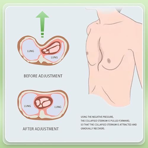 Taza de silicona de grado médico para corrección de Pectus Excavatum 3