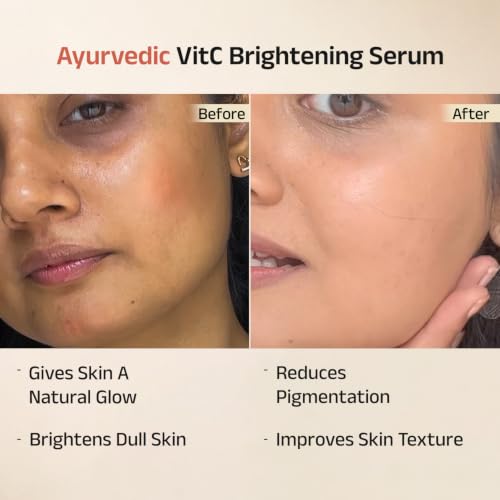 Image of Vedix Aloka Ayurvedic Glow & Brightening Face Serum for Tanned Skin | Vitamin C Serum with Amla, Yashtimadhu & Lemon | Helps Reduce Tan, Dullness & Uneven Skin Tone | 25 ml