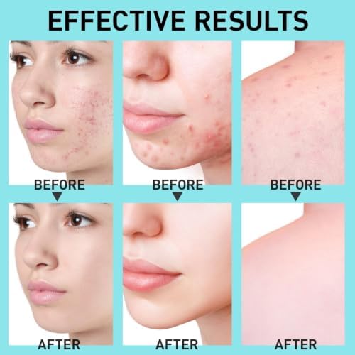 Salicylic Acid Acne Spot Treatment: Cystic Hormonal Pimple Cream for Stubborn Zits, Blemish Breakout & Post-Acne Scars - Face, Body & Back, Teens-Adults, 1.8 oz — view 2