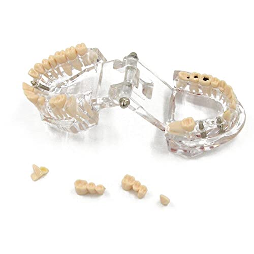Modèle dentaire de restauration Hrippy pour comprendre l'implant