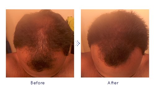 Miniatura 9 de Forila Corrector de pérdida de cabello de fibras de construcción de cabello, 0.81 oz - marrón oscuro