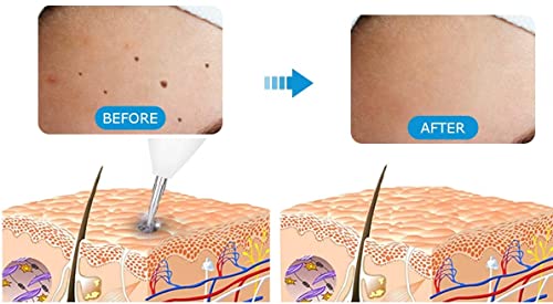 Image of Prague 20 Pcs Laser Mole Remover Fine Needles for Laser Mole Removal Pen