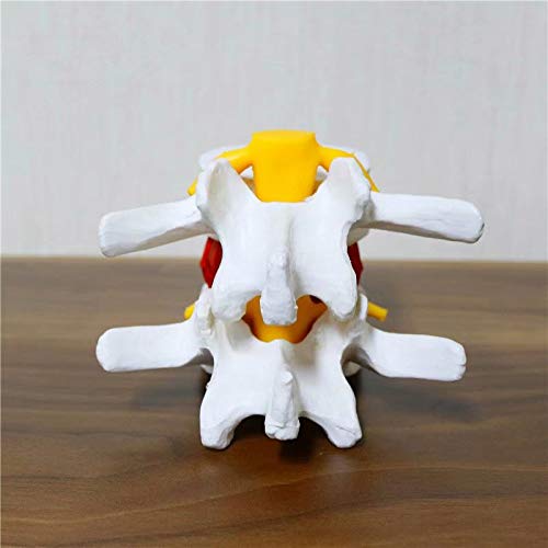 Miniatura 3 de Anatómica Hernia Lumbar Vértebras Disco Prolapso Modelo Anatomía Humana Modelo Blanco
