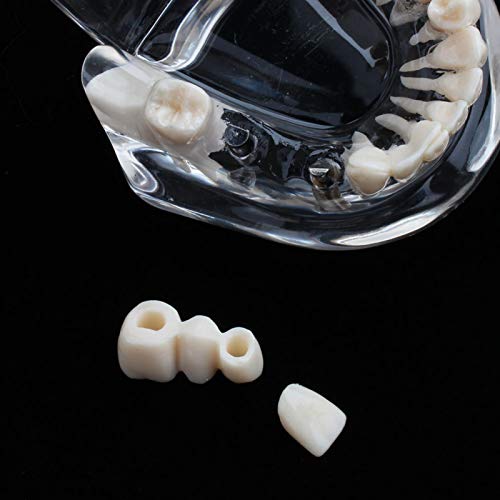 Transparent Dental Disease Model, Standard Implant Demonstration Teeth Model for Dental Disease Teaching Study, Typodont Teeth Model by PUSOKEI - Image 3