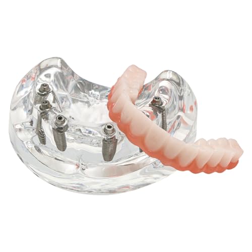Dental Implant Teaching Model, Upper Jaw with 6 Implant Posts and Prosthetic Bridge, Clear Base