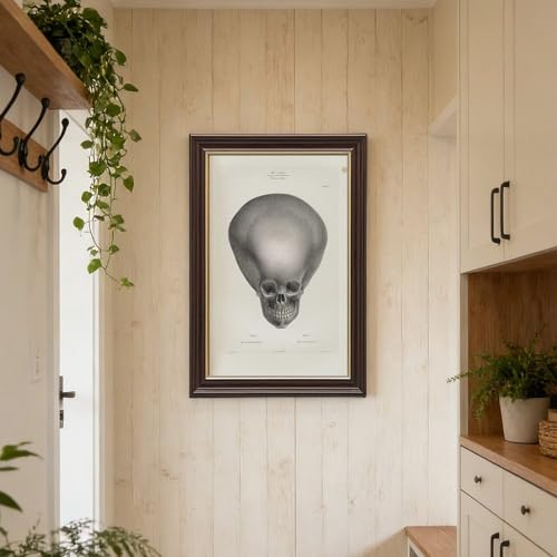 Toile crâne d'hydrocéphalie Joseph Vimont cadre suspendre 20x30cm - 6