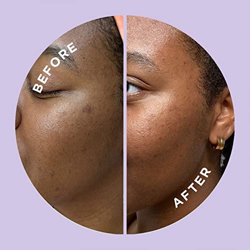 ZitSticka Hyperfade Patches for Face, World's Most Potent Pimple Patch with Fast-Acting Microdarts - Image 4