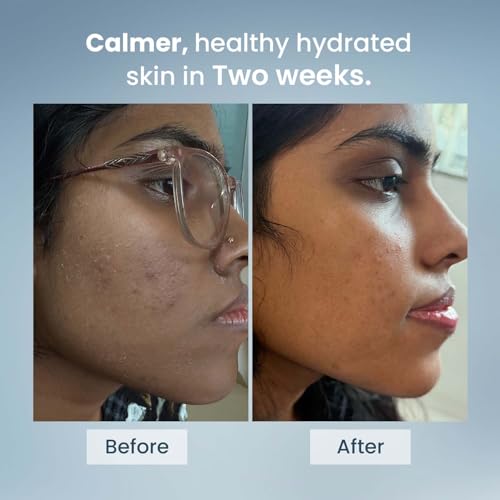 Image of The Solved Skin Barrier Repair Intense Moisturiser | Deeply Hydrating, Soothing Cream for Dry, Flaky & Sensitive Acne-Prone Skin | 50ml (Pack of 1)