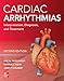 Cardiac Arrhythmias: Interpretation, Diagnosis and Treatment, Second Edition