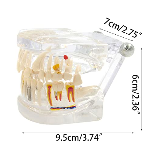 Modèle de dents transparent avec implants amovibles pour cabinet dentaire et étude - 3