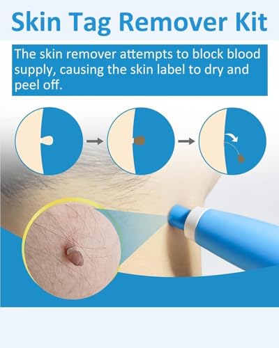 Image of Skin Tag Remover Kit for Face & Body, Upgraded Fast and Easy Removal Pen for Small to Large Size 2mm-8mm, Safe and Painless Clear Skin Tag & Mole, with 40 Removal Bands & 10 Cleansing Wipes