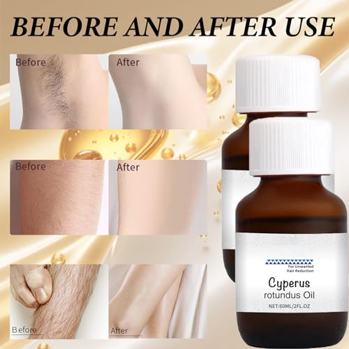 Cyperus Rotundus Oil,Ätherische Öle Cyperus,Cyperus Rotundus Öl zur Haarentfernung, Zur Reduzierung Des Körperhaarwachstums,Anwendbar auf Hautpflege,2 Stück