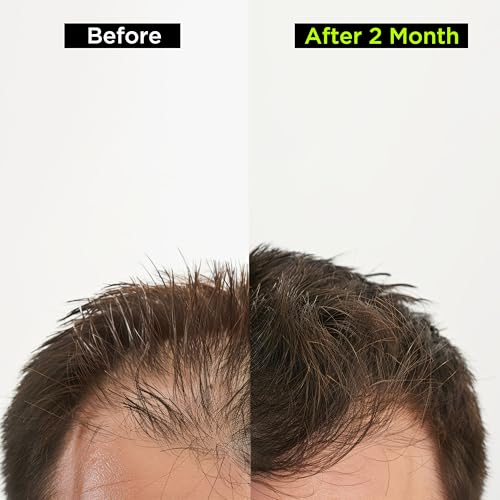 Health Veda Organics Advanced Hair Vitamin Nutrition | 60 Veg Capsules (Pack of 2) | Biotin + DHT Blocker for Hair Growth, Thickness & Hair Fall Control | For Men & Women