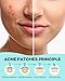 Pimple Patch Acne Patch, 4 Sizes 140 Patches Acne Absorbing Cover Patch, Hydrocolloid Invisible Acne Patches for Face Zit Patch Acne Dots Tea Tree, Calendula Oil