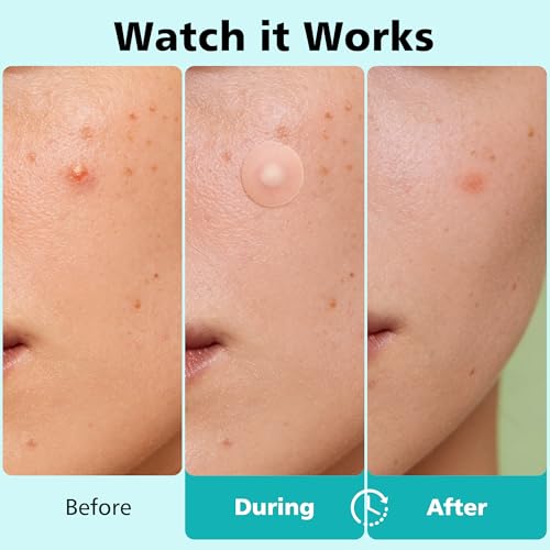 Pimple Patches for Face - 4 Size 600 Counts Acne Patches, Hydrocolloid Patches for Covering Zits and Blemishes, Spot Stickers with Salicylic Acid, Tea Tree Oil & Calendula Oil - Image 4