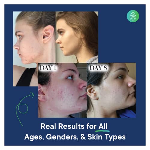 OrganiClear Acne Treatment System Kit for Face - Gentle Benzoyl Peroxide Cream - Deep Clean Exfoliating Salicylic Acid Face Wash Cleanser - Soothing Facial Lotion - 30 Day Complete Acne Skin Care Kit