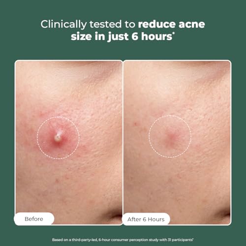 Image of Conscious Chemist Rapid Relief Acne Spot Corrector Gel | 15g | Triple-Action Treatment with 2% Salicylic Acid & Azelaic Acid | Clears Pimples, Reduces Redness & Fades Dark Spots | For Men & Women