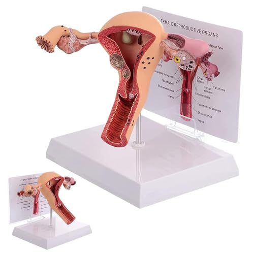 HEAXIY Female Reproductive Organs Uterus Anatomy Model, Pathological Uterus and Ovary Anatomical Model for School Hospitals Teaching Medical Anatomy