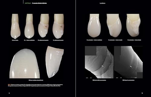 Faccette In Composito. La Tecnica Diretta-Indiretta - 3