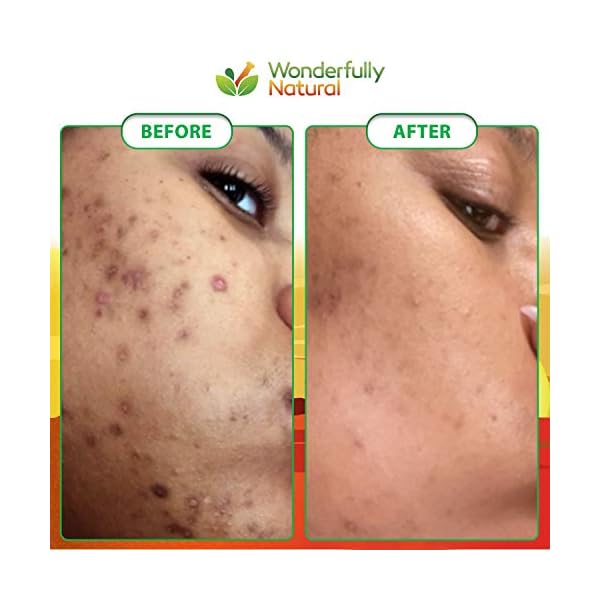 Organic African Black Soap - For Acne & Dark Spots | Natural Vegan and Cruelty Free â Satisfaction Guarantee 1lb bar | 90 day Supply