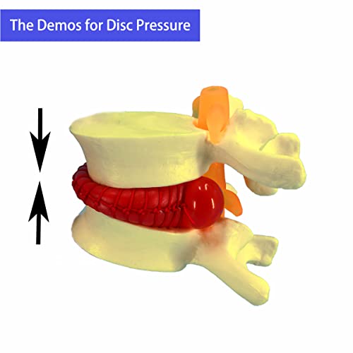 Disc Model Back Buy Veipho Human Anatomical Lumbar Disc Herniation Model, 1.5 Times ...