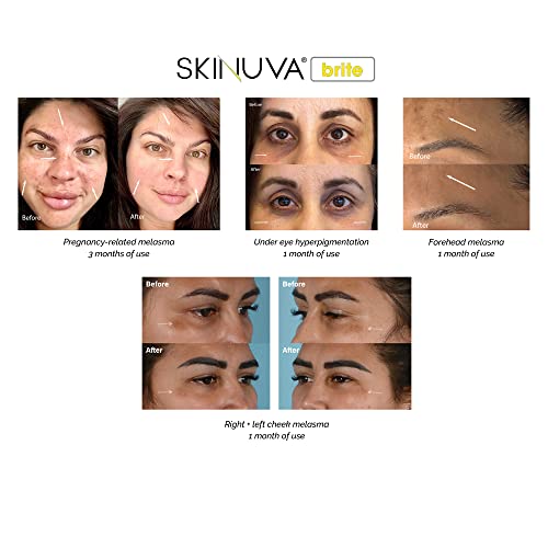 Skinuva Brite Dark Spot Treatment Cream for Face & Body